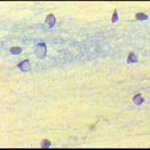 εικόνα δακτυλιδιού (Siegelringzellen),